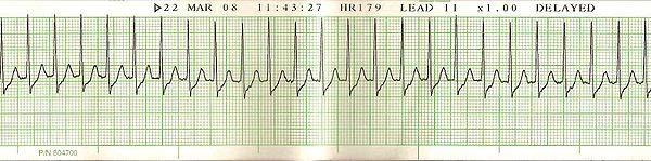 Taquicardias Chamamos de taquicardia sempre que observarmos a frequência cardíaca acima de 100 bpm.