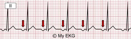 Taquicardia atrial: nesse caso existe apenas um foco ectópico atrial isolado gerando estímulos numa frequência mais alta do que o nó sinusal e a