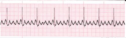 Flutter Atrial: definido por contrações atriais rápidas, regulares, de ondas P idênticas, dentes em serra com frequência 220-350.