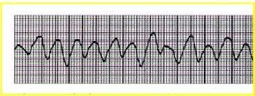 Fibrilação Ventricular (Parada Cardíaca): atividade elétrica totalmente irregular e rapidamente fatal, não se distingue os complexos, pode terminar em assístolia fatal.