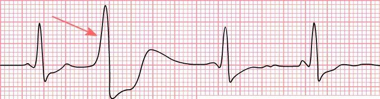 Extra-sístole Atrial ou Arritmia Sinusal: um foco ectópico atrial produz uma onda