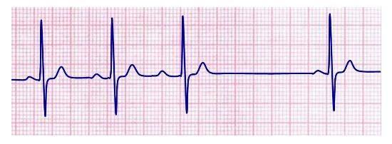 Bloqueios cardíacos: Bloqueio Atrioventricular 1º grau (BAV 1º grau): Ocorre apenas um prolongamento do tempo de condução do estimulo dos átrios para os