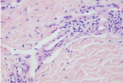 Sinal do promontório em maior ampliação. Fig 3B - Fase histológica de placa. Infiltrado linfo-plasmocitário.