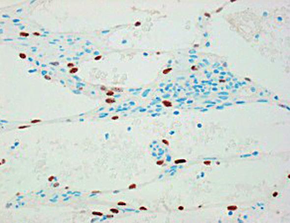 Proliferação de células fusiformes