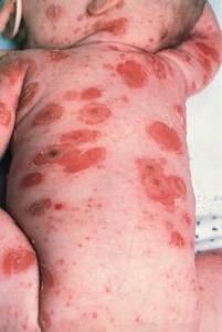 Herpes neonatal ð HSV-1 e HSV-2 1-2 semanas após nascimento lesões localizadas ð infecção disseminada alta