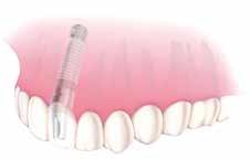 Os substitutos de um único dente têm uma aparência e proporcionam uma sensação tão naturais que, normalmente, apenas o paciente e o dentista reconhecem a diferença.