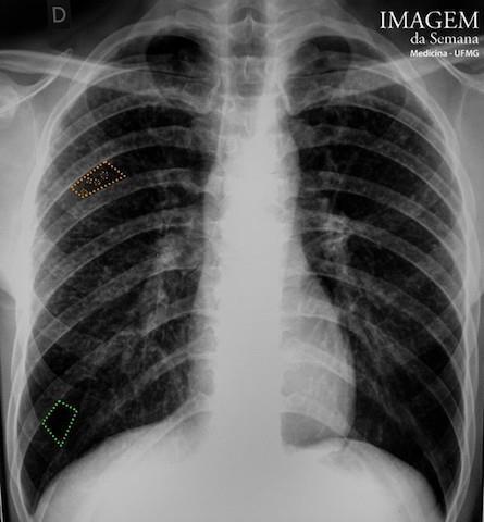 Radiografia e Tomografia Computadorizada Análise das Imagens Imagem 1: Radiografia simples de tórax, incidência posteroanterior.