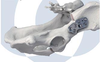 instrumentation), ou ate uma placa especialmente desenhada tal como a Slocum Canine Osteotomy Plate. (DENNY 2006).