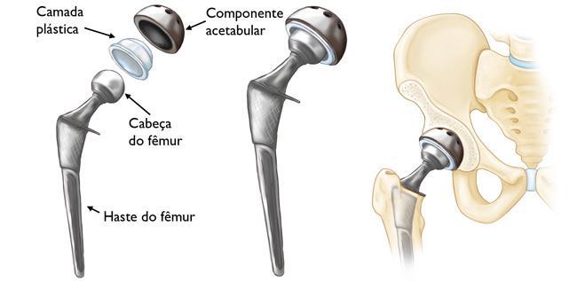 38 Figura 15: componentes individuais de uma artroplastia total Fonte: American Academy of Orthopaedic Surgeons.