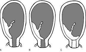 Figura - Tipos de placenta prévia Fonte: Google imagens.