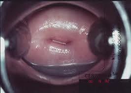 Coleta do material para exame colpocitopatológico: A coleta do material do colo do útero para exame colpocitopatológico deve ser realizada a partir de uma amostra da parte externa, a ectocérvice.