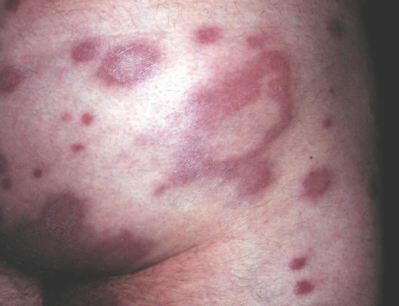 3. Lesões Anulares: Hanseníase (dimorfa) Tinha do corpo Granuloma anular Eritema