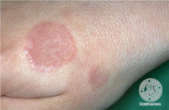 Granuloma