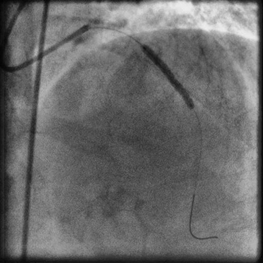 ANTERIOR CORONARIOGRAFIA ESQUERDA