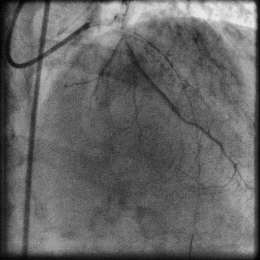 STENT REVESTIDO RESULTADO FINAL