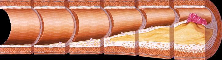 doença coronária e de acordo com o risco do doente (isquémico e hemorrágico) Foam Cells Fatty