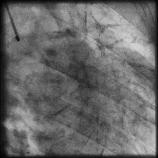Caso Clinico #3 Cateterismo cardíaco Coronariografia esquerda Caso Clínico #3 QUIZZ ONLINE: A DOENTE FEZ