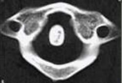 Junção craniocervical Instabilidade atlanto axial