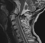 neurologicamente estáveis Síndrome de Down, AR,