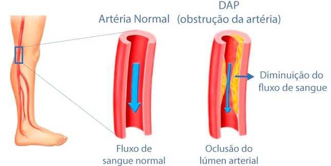 Doença Arterial Obstrutiva Periférica A doença arterial periférica é uma manifestação comum da aterosclerose