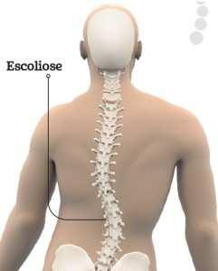 Escoliose A escoliose refere-se ao desvio anormal da coluna vertebral provoca dor e deformação.