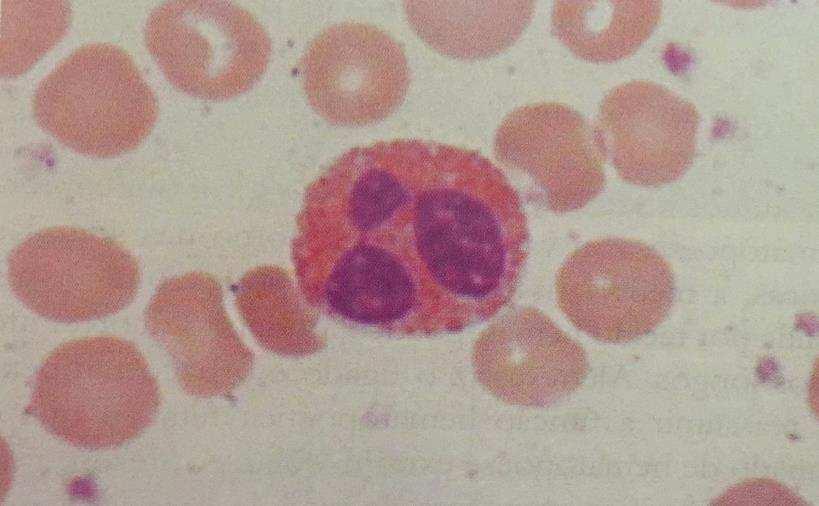 OS EOSINÓFILOS Os eosinófilos originam-se na medula óssea e tem a característica peculiar de apresentar no citoplasma grânulos com alta afinidade pela eosina, um corante ácido utilizado nas