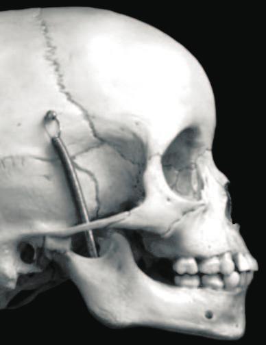lterações na dimensão transversal pela expansão rápida da maxila Haas 10, investigando correções ortopédicas e ortodônticas de dez pacientes tratados pela ERM, comprovou uma estabilidade de 4 a 5mm