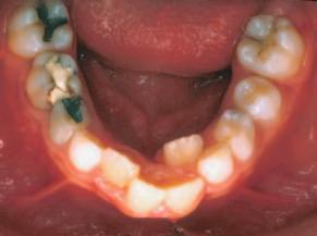 Lima, Lima, Lima Filho e Oyen 20, estudando pacientes Classe I tratados exclusivamente com ERM durante a dentadura mista, constataram uma expansão espontânea no arco inferior e notável estabilidade