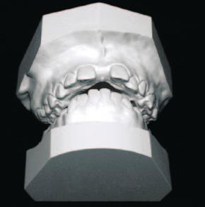 relação ideal é manter contato entre as cúspides linguais dos dentes posterossuperiores com as cúspides vestibulares dos posteroinferiores. sobrecorreção (Fig.