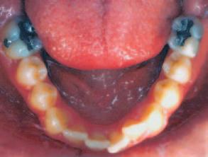 Quando as proporções entre a maxila e a mandíbula estão alteradas entre si, ou em