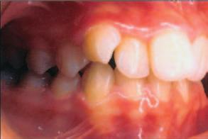 Essas deformidades podem ocorrer, na maxila e/ou mandíbula, nas três dimensões do