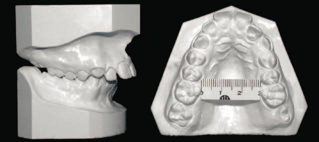 má oclusão de Classe II pode mascarar a deficiência maxilar transversal, pois os dentes