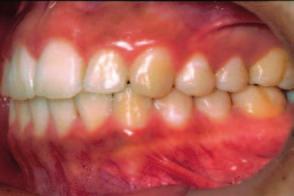 mandíbula. abertura da base apical maxilar libera a mandíbula para mover-se anteriormente, visando a correção parcial da relação de Classe II molar.