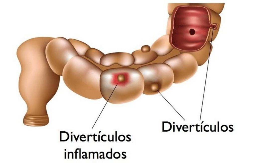 3.4 DIVERTICULITE AGUDA É o processo inflamatório que acomete os divertículos, que são pequenas bolsas que estão presentes na parede interna do intestino.