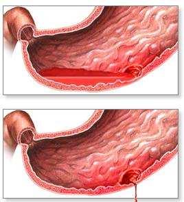 3.6 HEMORRAGIA DIGESTIVA (ALTA E BAIXA) A hemorragia digestiva alta (HDA), é uma doença que possui uma alta mortalidade.