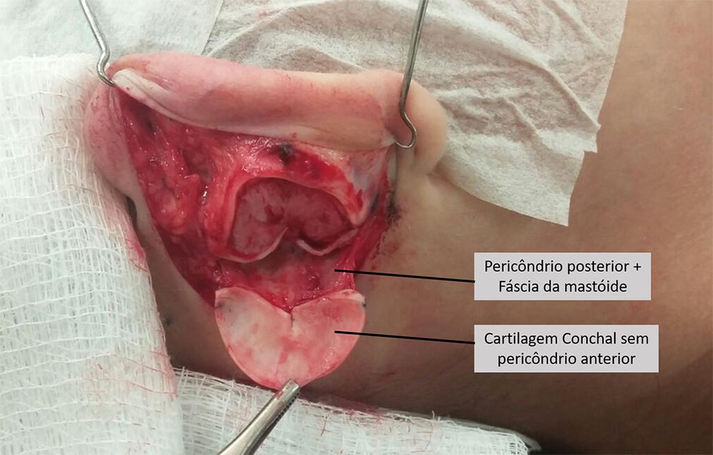 A cirurgia proposta foi realizada através da técnica aberta. O trabalho foi aprovado pelo Comitê de Ética e Pesquisa da Faculdade de Medicina de São José do Rio Preto, sob o protocolo número 60203316.