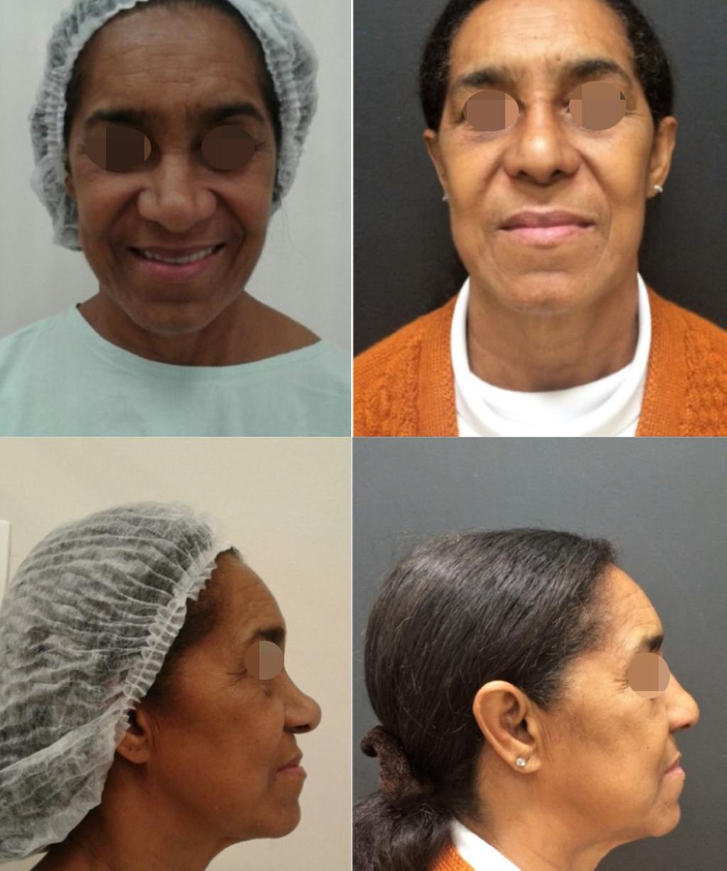 sensibilidade auricular. Os nove pacientes apresentaram-se satisfeitos (3) ou felizes (6) com o procedimento nasal.