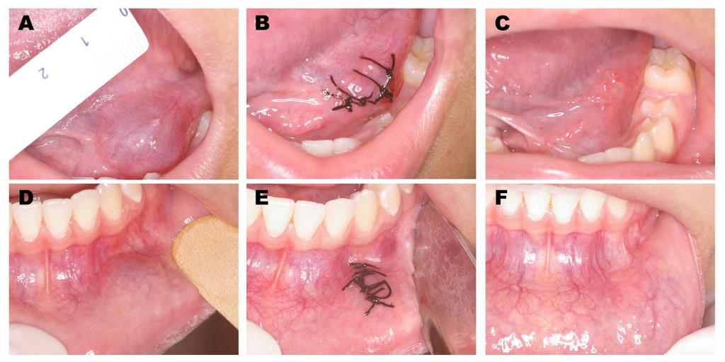 57 Figure 1 - Patients #3 and #12. Clinical aspects of oral ranula and selected mucocele treated with micro-marsupialization.