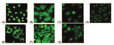 30 Figura 2: Padrões representativos de PAAC por imunofluorescência indireta em células HEp2 Padrão nuclear homogêneo (A), nuclear pontilhado grosso (B), centromérico (C), nucleolar (D),