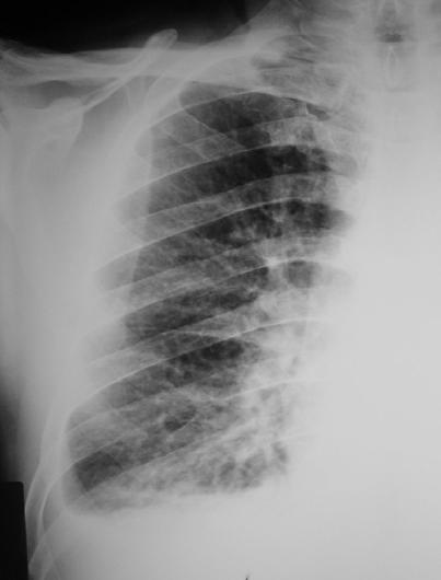 Padrão reticular no edema pulmonar.