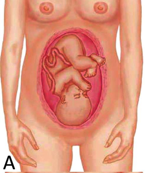 Atitude Figura 1 - Atitude fetal fisiológica: flexão generalizada A atitude fetal é definida como a relação das diferentes partes fetais entre si.