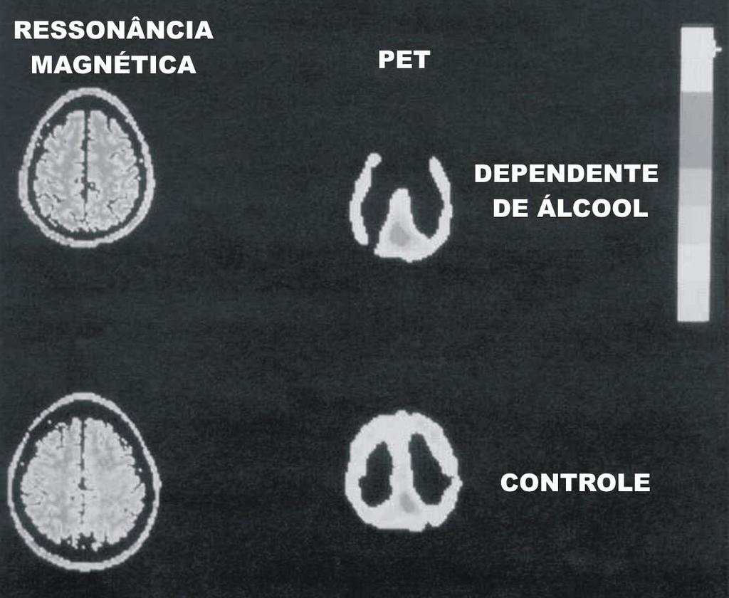 Neuroimagem e Álcool