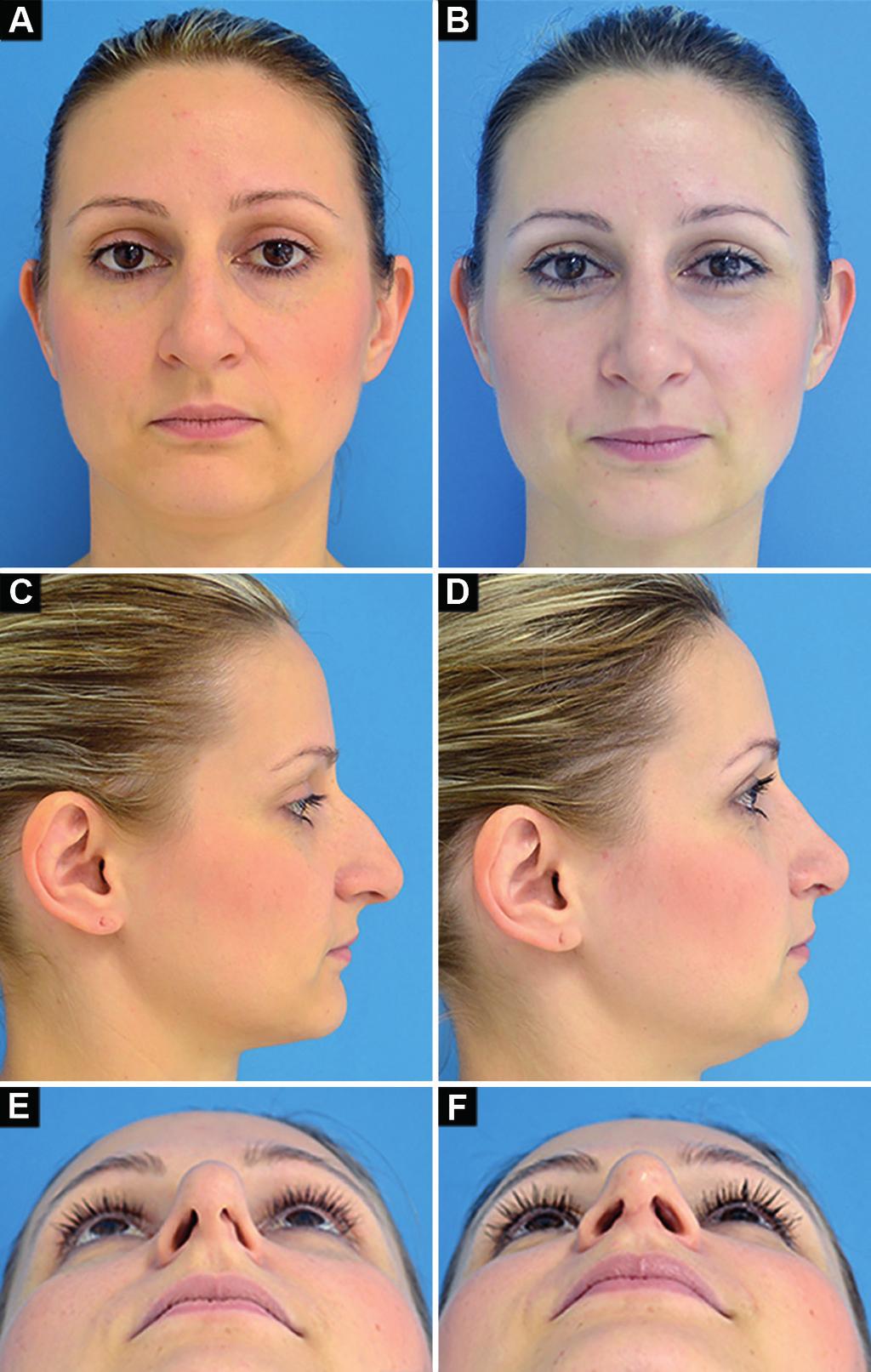 Caso 3: Vetor não adequado das cartilagens laterais inferiores e insuficiência total da válvula nasal externa à direita e parcial à esquerda.