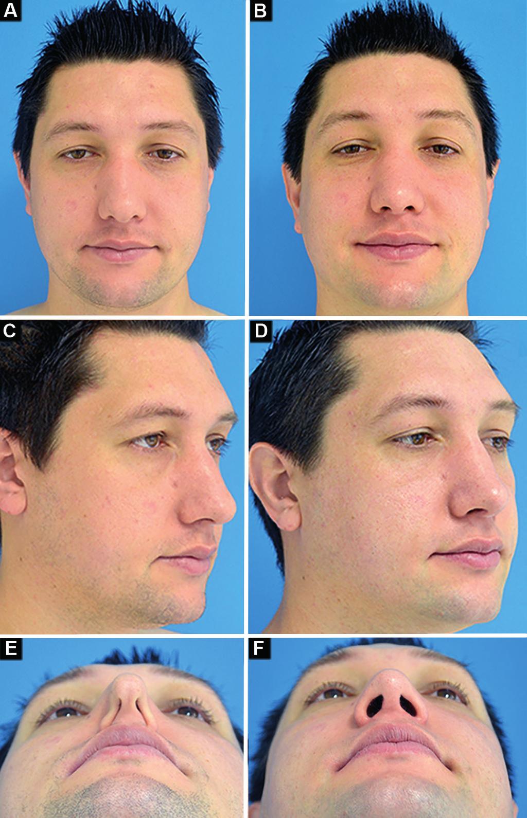 Avaliação pré e pós-operatória da válvula nasal externa em rinoplastia Figura 11. Pré e pós-operatório com 1 ano. A-B: Frontal; C-D: ¾, E-F: Inspiração profunda. Figura 12.