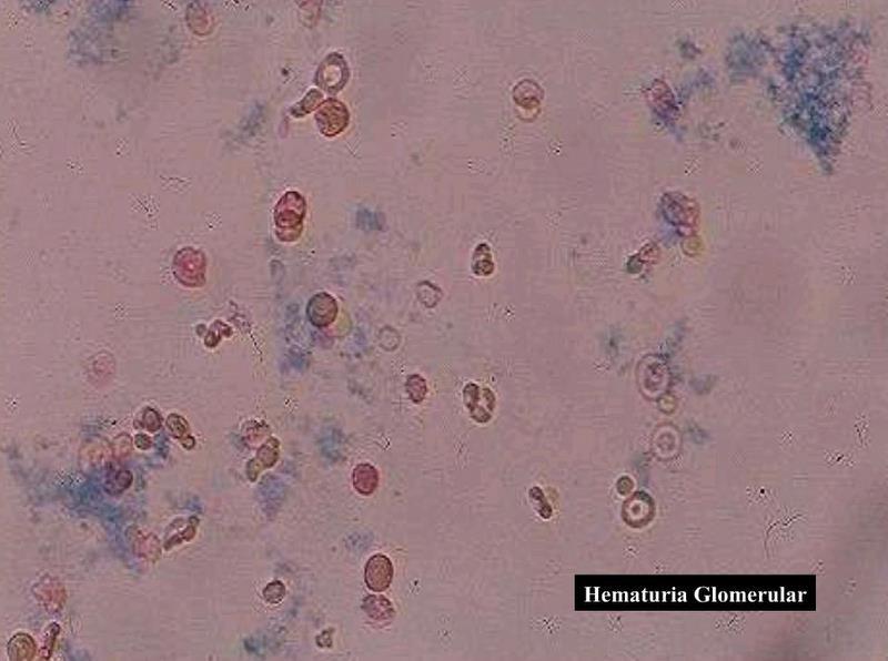 21 Figura 2: Hematúria glomerular com presença de dismorfismo eritrocitário. Fonte: TOMITA et al., (1992). Figura 3: Hematúria não glomerular com presença de hemácias isomórficas.