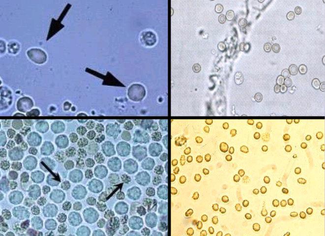 entre hematúrias glomerulares e não-glomerulares, se firmando não apenas no encontro de proteinúria e cilindrúria (Figura 4), mas também nas alterações morfológica das diferentes populações de