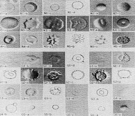 25 As células G1 começaram a ser descritas por TOMITA et al. (1992), caracterizadas por sua forma de rosca e podendo indicar uma ou mais projeções vesiculares em sua superfície.