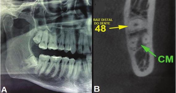 INTRODUÇÃO A coronectomia ou odontectomia parcial intencional (OPI) é uma técnica, que visa remover, apenas, a coroa do dente incluso, deixando a raiz intacta.