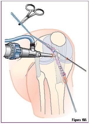 femoral (figura 9B).O enxerto é então levado no furo femoral até a marca de 30 mm no enxerto estar na entrada do túnel femoral.