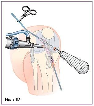 Mantendo a tração sobre o enxerto através das suturas distais e proximais, o parafuso CALAXO é avançado (Figura 11A).